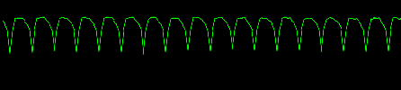 EKG pulseless ventricular tachycardia