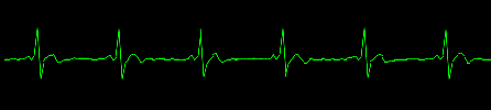 EKG sinus rhythm