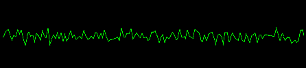 EKG ventricular fibrillation